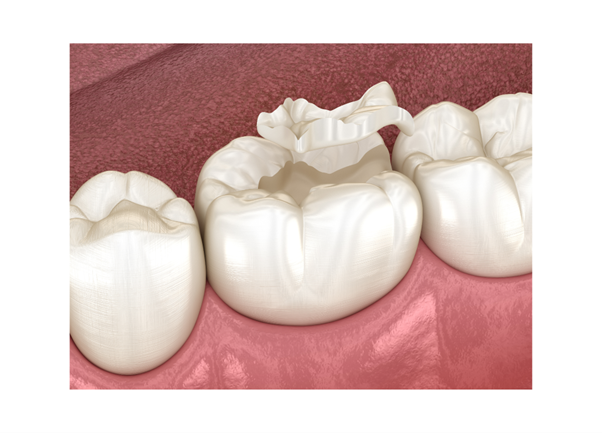 reconstruccion-dental-denia