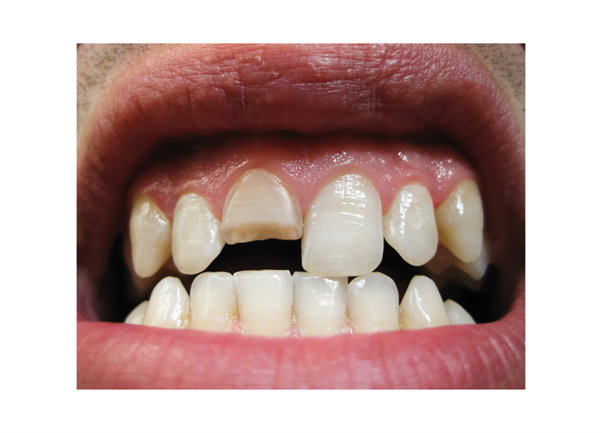 dientes fracturados
