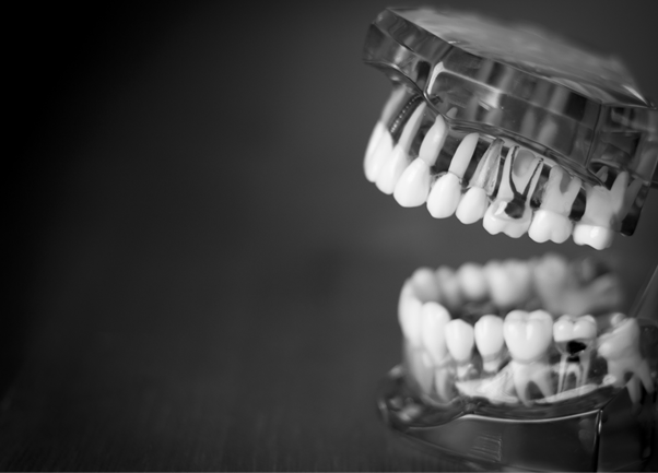 caries