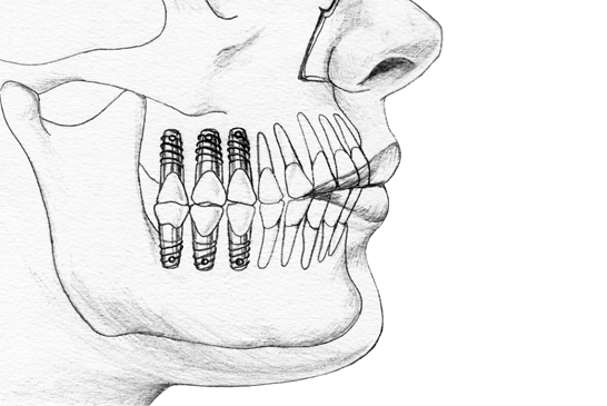 mantenimiento-implantes