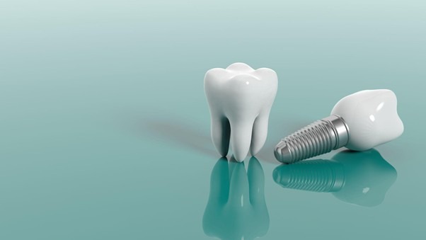 implante-dental