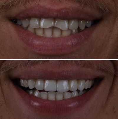 Ortodoncia-y-carillas-composite.jpg